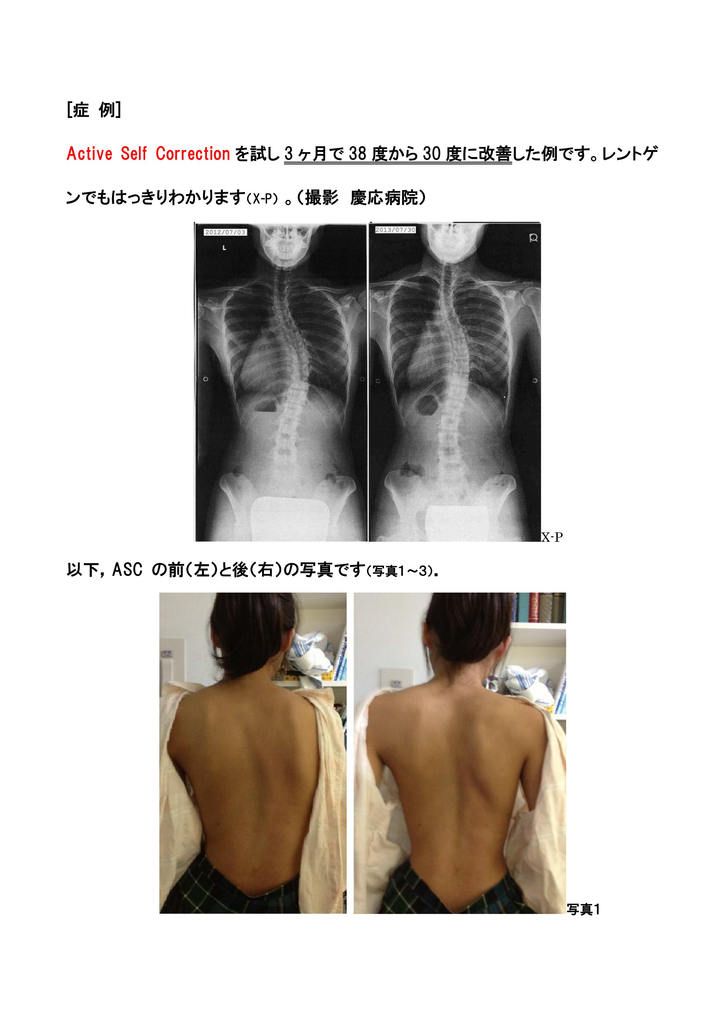 当院の石原がイタリアの側弯症の運動療法のテラピストとしてv2 4 03 麹町白石接骨院